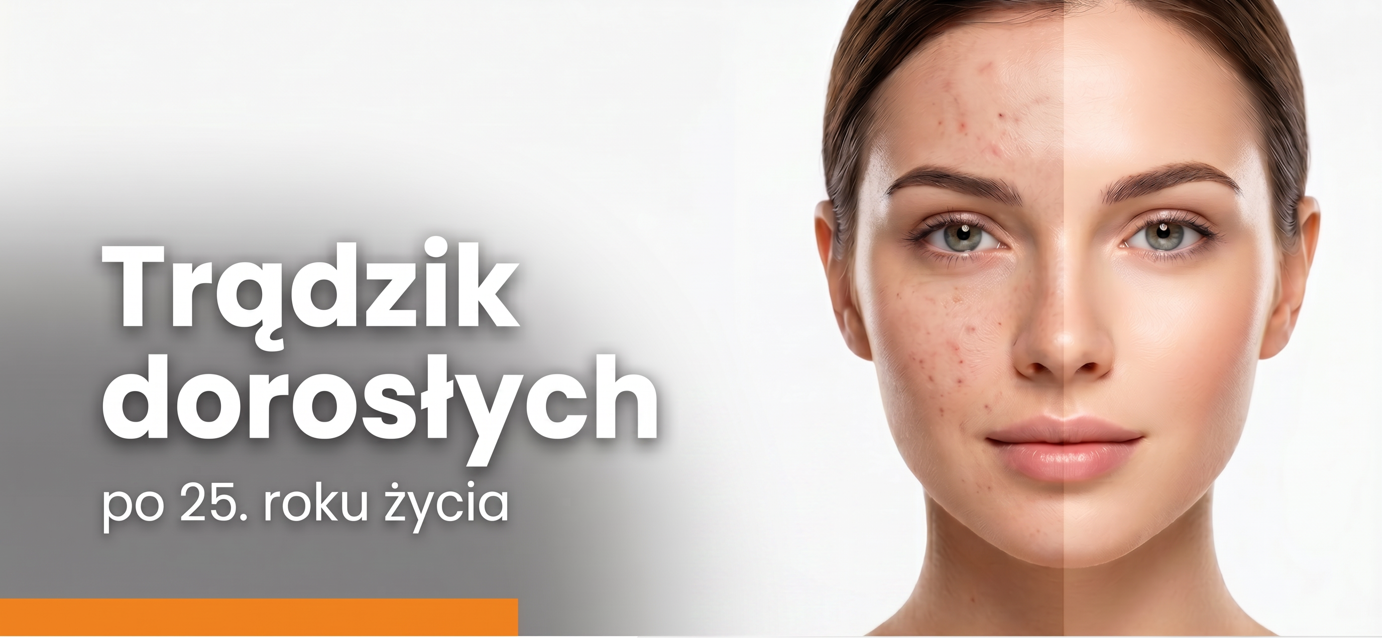 Trądzik dorosłych – dlaczego pojawia się po 25. roku życia i jak go leczyć dermokosmetykami?